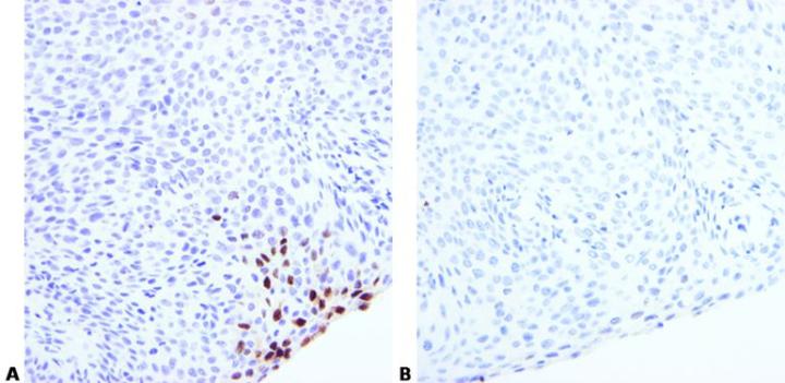 Both sections of condyloma were stained using ISH for HPV using the same DNA probe but different hybridization conditions. Section A shows strong staining while in section B staining is unsatisfactory.