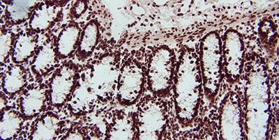 This section of colon has been stained with a Poly d(T) positive control probe. The section demonstrates the result of over digestion with Proteinase K. Note the loss of cytoplasmic structure in the mucosal epithelium and heavy background staining.