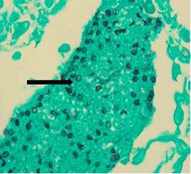 PNEUMOCYSTIS APPEAR AS BLACK BALLS WITH LIGHT GREEN BACKGROUND PNEUMOCYSTIS APPEAR AS BLACK BALLS WITH LIGHT GREEN BACKGROUND