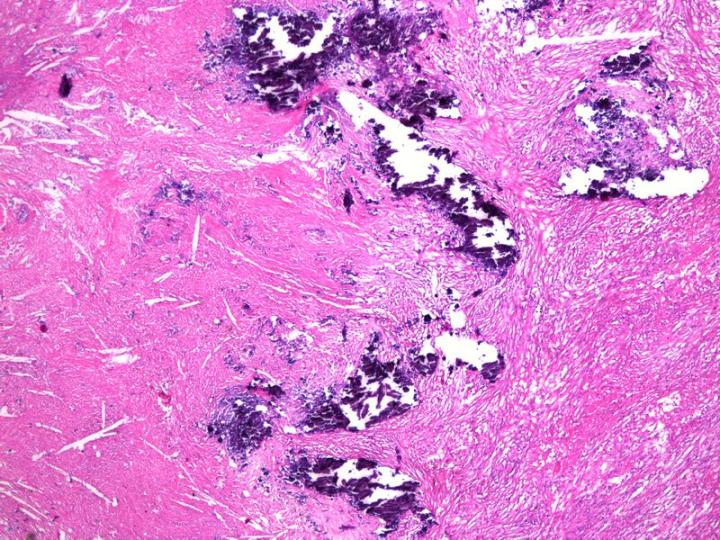 Figure 10: A section from a granuloma specimen in which unanticipated calcium deposits were encountered (blue). Sections of better quality could have been prepared if surface decalcification had been applied to this block.