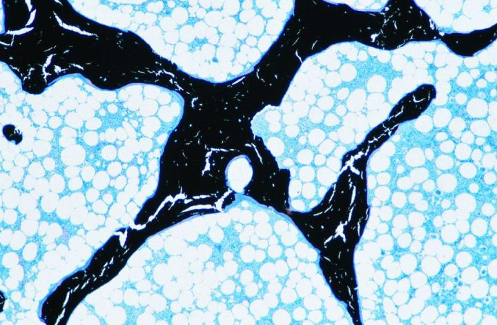Figure 2: An undecalcified section of cancellous bone (Von Kossa). The bone was fixed in formalin and processed and embedded in epoxy resin for sectioning. Calcified bone is black, and a rim of osteoid on the surface of the trabeculae is stained blue, as are the components of the bone marrow. Note that despite the support of polymerized resin, in this case, the calcified matrix has cracked during preparation of the section.