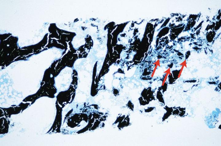 Figure 6: A trephine specimen in which bone fragments have been forced into the marrow spaces during preparation (arrows). This is an un-decalcified resin section stained with Von Kossa’s method to demonstrate calcium.