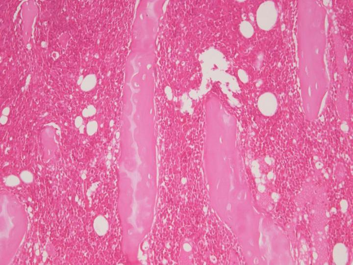 Figure 7: A section of decalcified cancellous bone (H&E). This specimen was decalcified with a hydrochloric acid decalcifier for an excessive time without using an appropriate endpoint test. Although the tissue elements are cohesive, the staining is very poor showing a complete absence of nuclear staining together with strong, poorly-differentiated eosin.