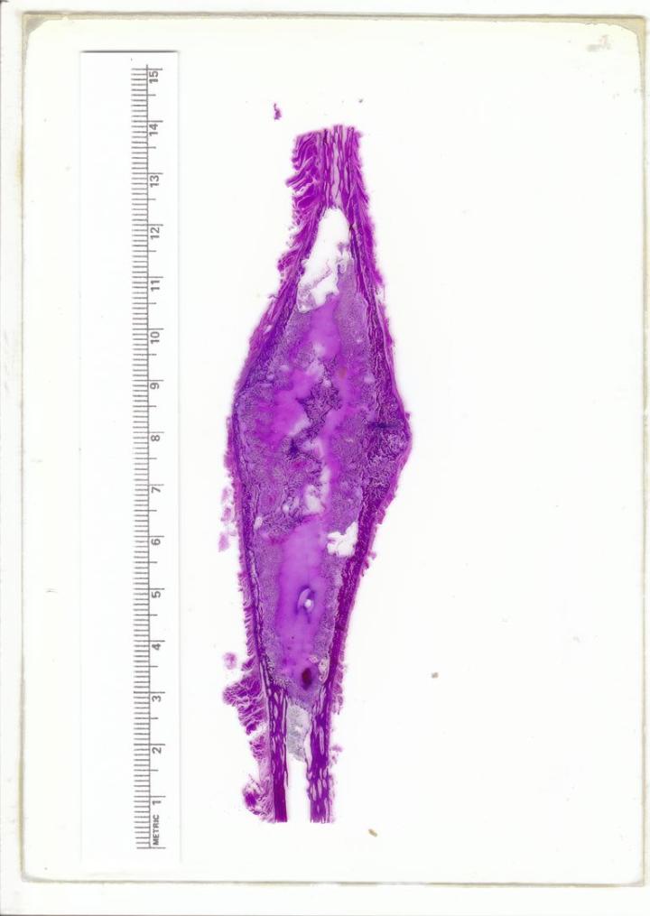 Hình 9: Phần parafin được khử keo của xương mác (H&E). Lưu ý kích thước của mẫu vật. Nó được khử keo bằng tác nhân axit formic bằng cách sử dụng thử nghiệm điểm cuối hóa học, sau đó được xử lý thành parafin theo một lịch trình kéo dài. Nam sinh 13 tuổi bị gãy bệnh lý xương mác bên phải sau một cú ngã. X-quang cho thấy xương phì đại ở trục giữa của xương mác (R). Chẩn đoán bệnh học là u xương có gãy xương bệnh lý.