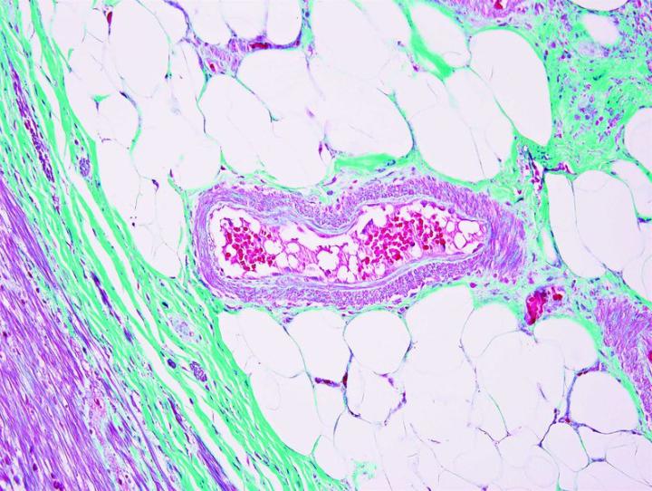 Gomori Trichrome (green) (submucosa). Trichrome stains are used to stain and identify muscle fibers, collagen and nuclei. They can be used to contrast skeletal ,cardiac or smooth muscle. The Gomori Trichrome is a simplification of the more elaborate Masson stain and combines the plasma stain (chromotrope 2R) with the connective tissue stain to provide a brilliant contrasting picture.