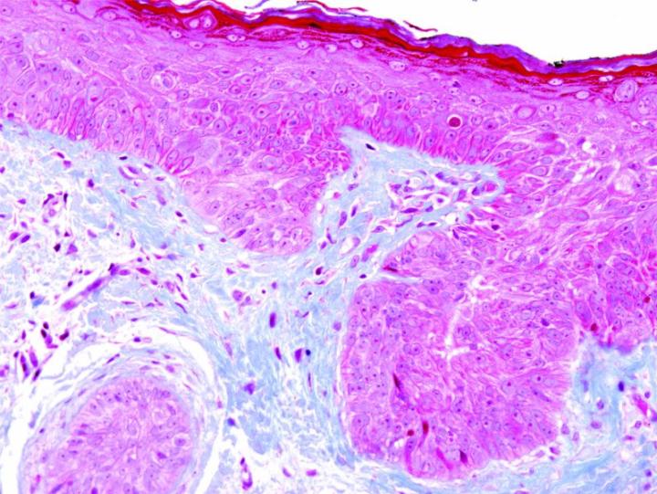 The Masson’s Trichrome Stain Kit is intended for use in histological observation of collagenous connective tissue fibers in tissue specimens. It is used to assist in differentiating collagen and smooth muscle in tumors and assists in the detection of di