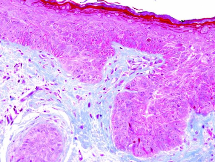 Figure 8: Masson's Trichrome (skin). This stain is intended for use in histological observation of collagenous connective tissue fibers in tissue specimens. It is used to assist in differentiating collagen and smooth muscle in tumors and assists in the detection of diseases or changes in connective/muscle tissue. The Masson’s Trichrome Stain Kit is intended for use in histological observation of collagenous connective tissue fibers in tissue specimens. It is used to assist in differentiating collagen and smooth muscle in tumors and assists in the detection of di