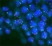 Bladder cancer Bladder cancer