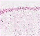Cyclin D1 red nuclear stain Cyclin D1 red nuclear stain