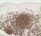 CD20 brown membranous stain CD20 brown membranous stain