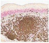 Normal human tonsil stained with CyclinD1 red nuclear stain, CD20 brown membranous stain, and hematoxylin counterstain Normal human tonsil stained with CyclinD1 red nuclear stain, CD20 brown membranous stain, and hematoxylin counterstain