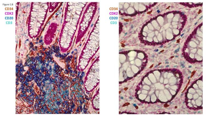 Figure 1B The value of multiplex staining Figure 1B The value of multiplex staining