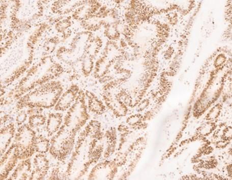 MSH6 primary antibody IHC with hematoxylin counterstain, 20X magnification