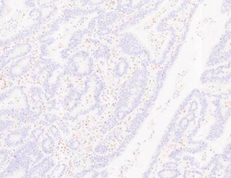 PMS2 primary antibody IHC with hematoxylin counterstain, 20X magnification