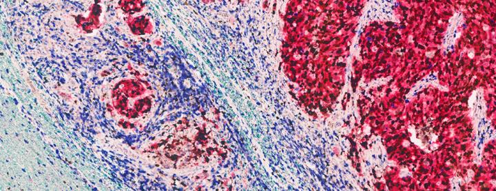 Multiplex Staining 5-Plex