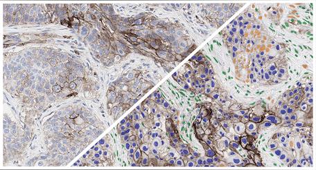 HALO-AI-NSCLC-IHC-Cancer-Cell-Phenotyper