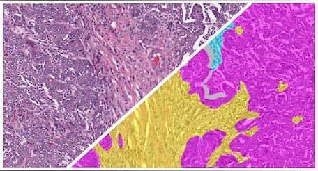 HALO-AI-Ovarian-H&E-Tumor-Tissue-Detection