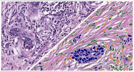 HALO-AI-Pan-Cancer-H&E-Lymphocyte-Cell-Phenotyper