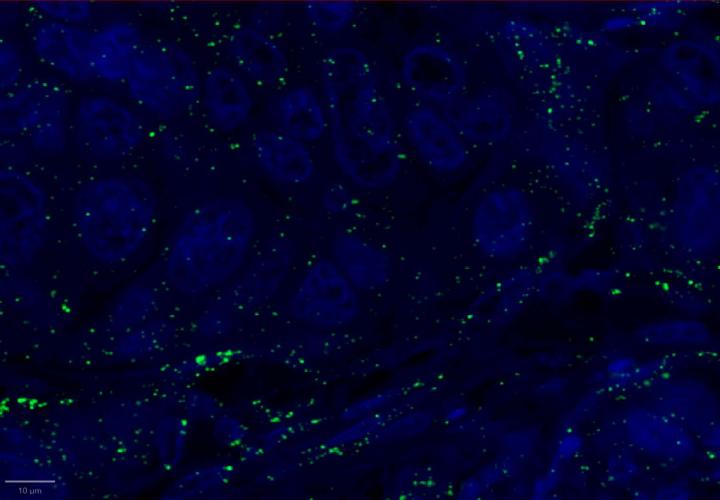 PPIB Positive Control Multiomic Staining in Breast Cancer
