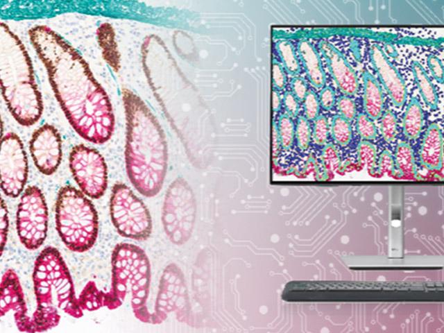 Illustration of Chromogenic Stain of Human Tissue with ChromoPlex III and Digital Pathology Image Analysis