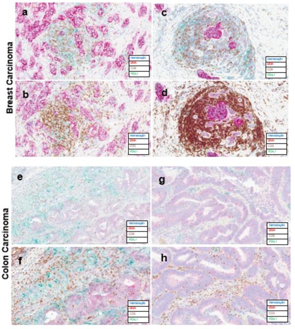 ChromoPlex III stains of Breast and Colon Carcinomas