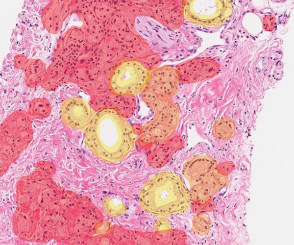 DeepDx Prostate (IVD)