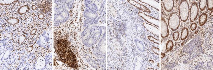 MLH1, MSH2, MSH6, and PMS2 staining performed using the Leica Biosystems BOND MMR antibody panel on the BOND-III automated staining platform