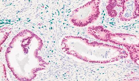 Adenocarcinoma-in-human-colon-stained