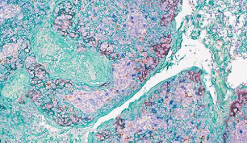 Melanoma-in-skin-stained-2