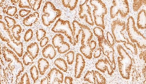 Case-A_MLH1_protein-intact