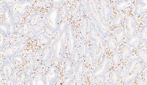 Case-A_MSH2_protein-loss