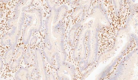 Case-A_MSH6_protein-loss