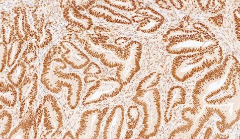 Case-A_PMS2_protein-intact