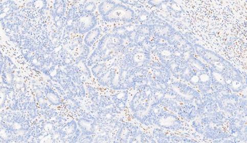 Case-B_MLH1_protein-loss