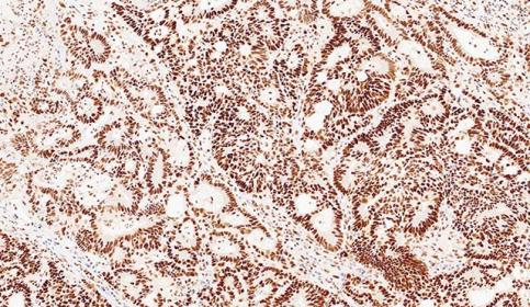 Case-B_MSH2_protein-intact