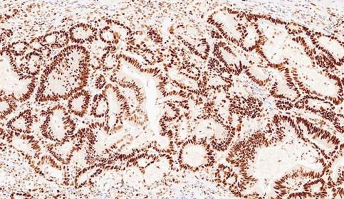 Case-B_MSH6_protein-intact