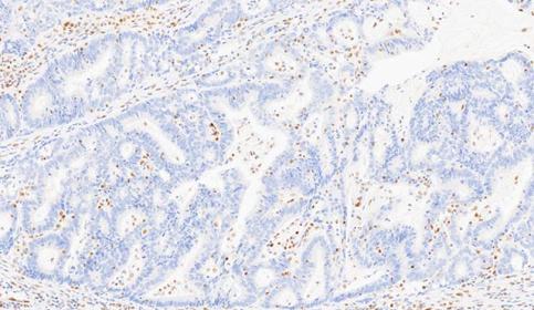 Case-B_PMS2_protein-loss