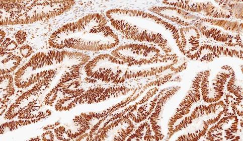 Case-C_MSH2_protein-intact