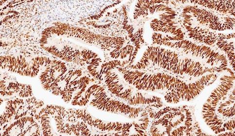 Case-C_MSH6_protein-intact