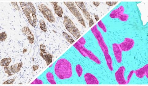 HALO-AI-Breast-IHC-Tumor-Tissue-Detection