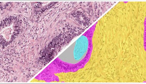 HALO-AI-Gastric-H&E-Tumor-Tissue-Detection