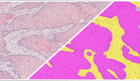 HALO-AI-HNSCC-H&E-Tumor-Tissue-Detection