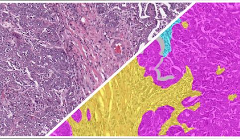HALO-AI-Ovarian-H&E-Tumor-Tissue-Detection