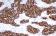 Human breast carcinoma: immunohistochemical staining for c-erbB-2 oncoprotein using Bond Oracle HER2 IHC System. Note intense membrane staining of tumor cells. Paraffin section.